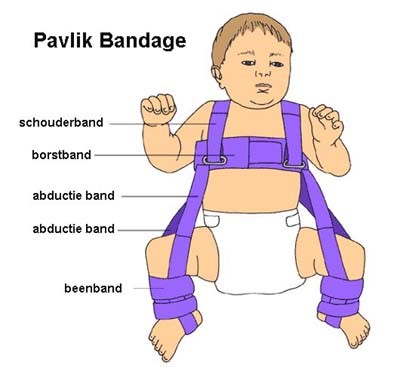 Kind met Pavlik-bandage